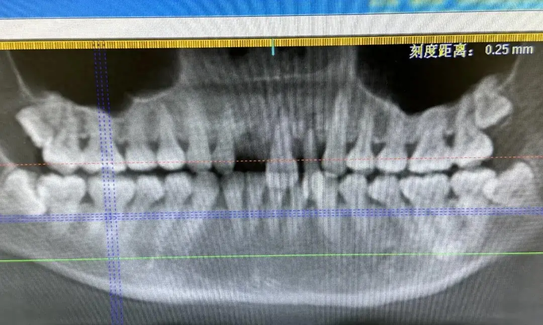 一晚上好几例！有人磕掉3颗门牙！医生：建议泡在牛奶里-图1